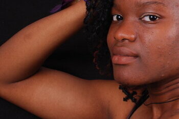 Ingredientes naturais para combater a acne